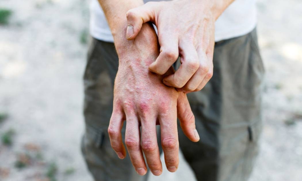 Ψωρίαση vs λύκος: Τα κοινά συμπτώματα και οι διαφορές