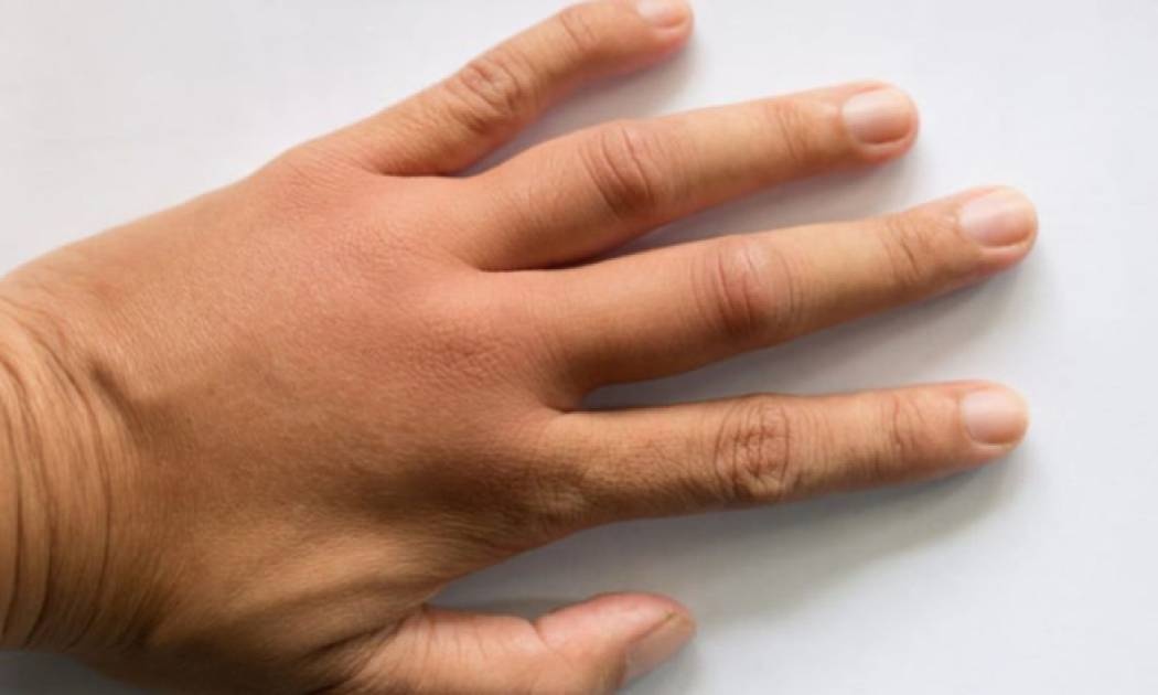 Δέκα σοβαρές παθήσεις που φαίνονται στα χέρια σας (εικόνες)