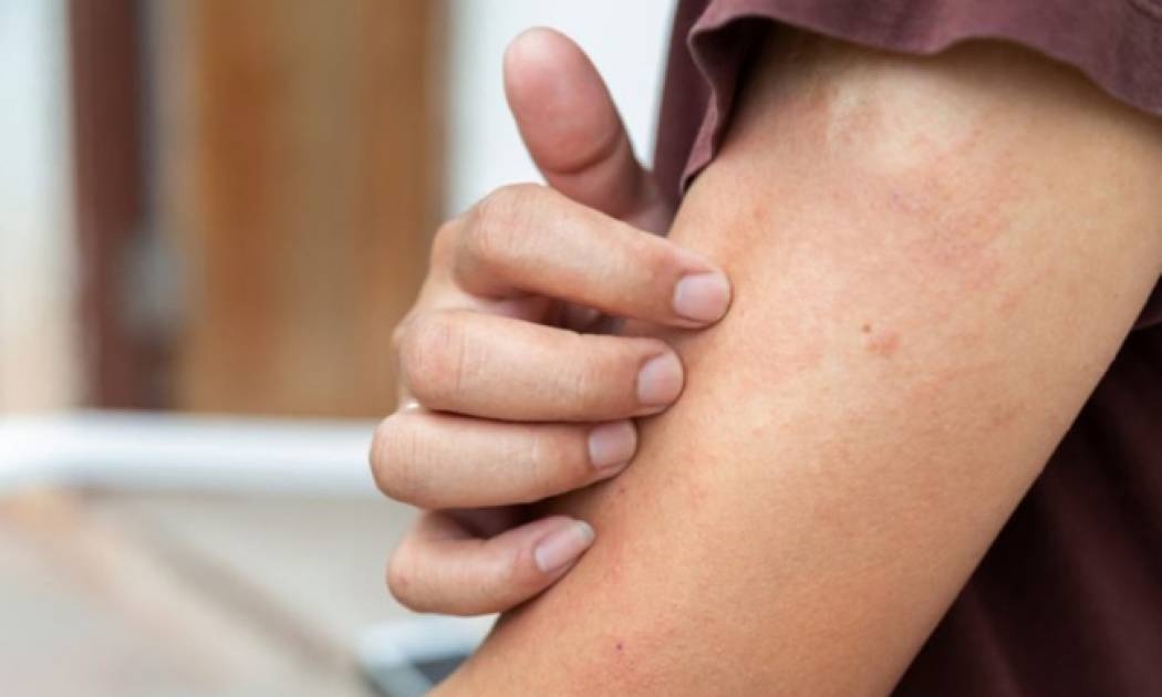 Έκζεμα: Το μπαχαρικό που βοηθά στην αντιμετώπιση της φαγούρας