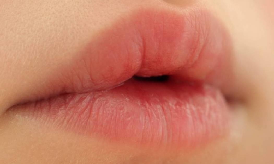 Ξηρά & σκασμένα χείλη: 7 αιτίες & πώς θα τα θεραπεύσετε