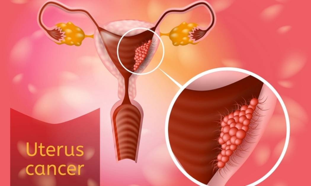 Καρκίνος τραχήλου: Το σύμπτωμα που αφορά το 90% των περιπτώσεων