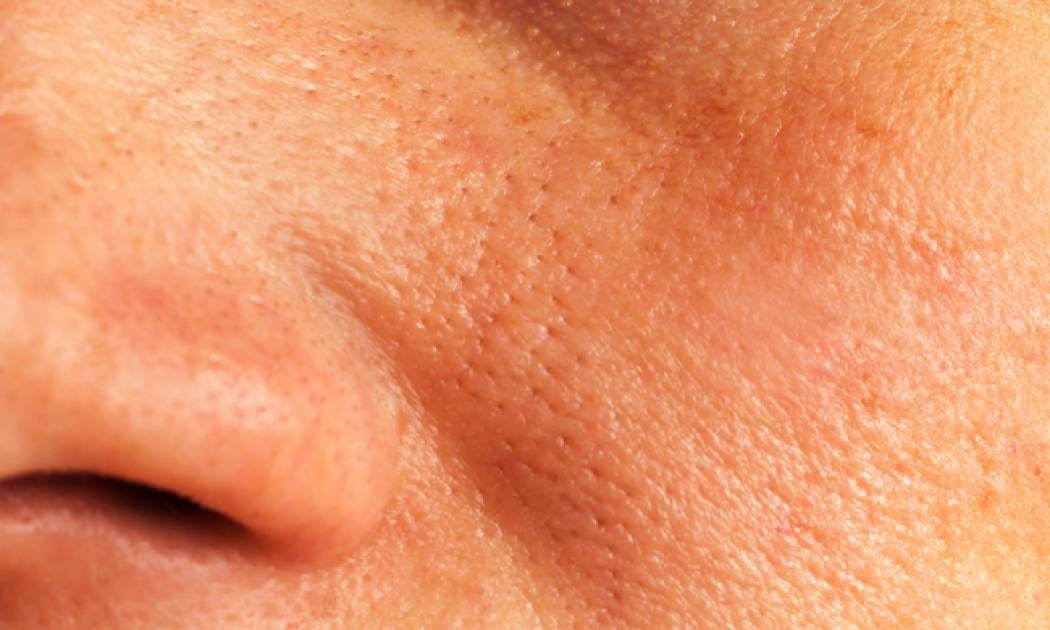 Οι συνήθειες που φράζουν τους πόρους του δέρματος