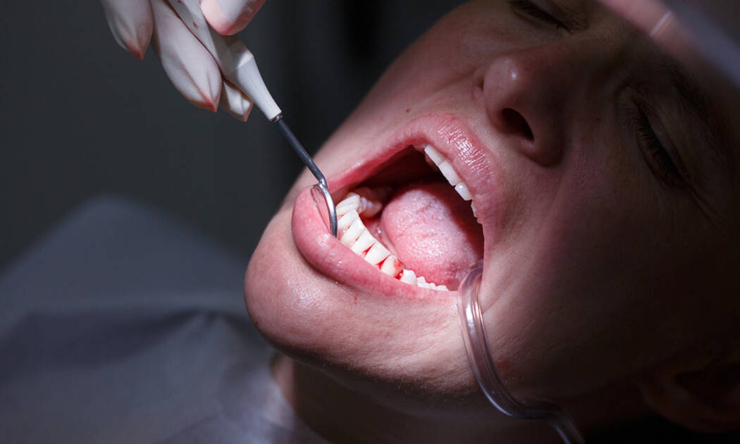 Υποχώρηση ούλων: Φυσικοί τρόποι αντιμετώπισης (video)