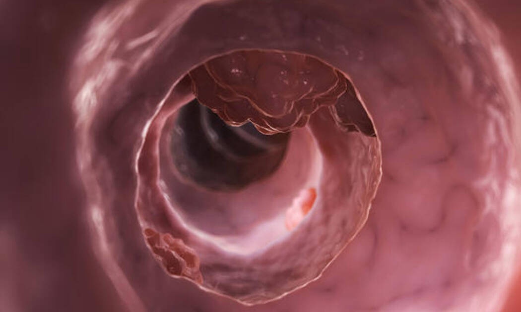 Καρκίνος εντέρου: Ποιες είναι οι ηλικίες που χτυπάει συχνότερα (αναλυτικά)