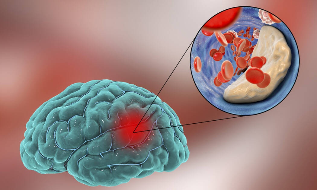 Εγκεφαλικό: Οι τροφές που μειώνουν τον κίνδυνο (εικόνες)