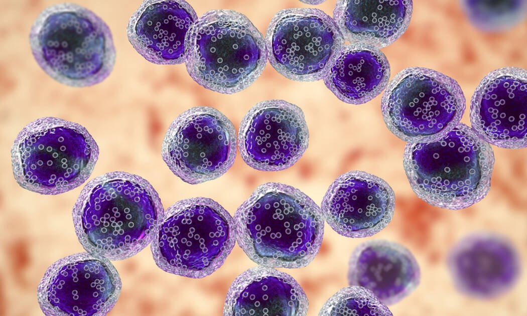 Αιματολογικός καρκίνος: Αυτά είναι τα ύποπτα συμπτώματα