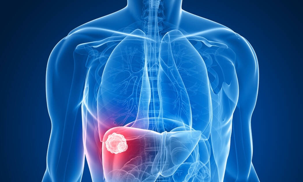 Καρκίνος στο συκώτι: Πώς θα προλάβετε τον «αθόρυβο δολοφόνο»