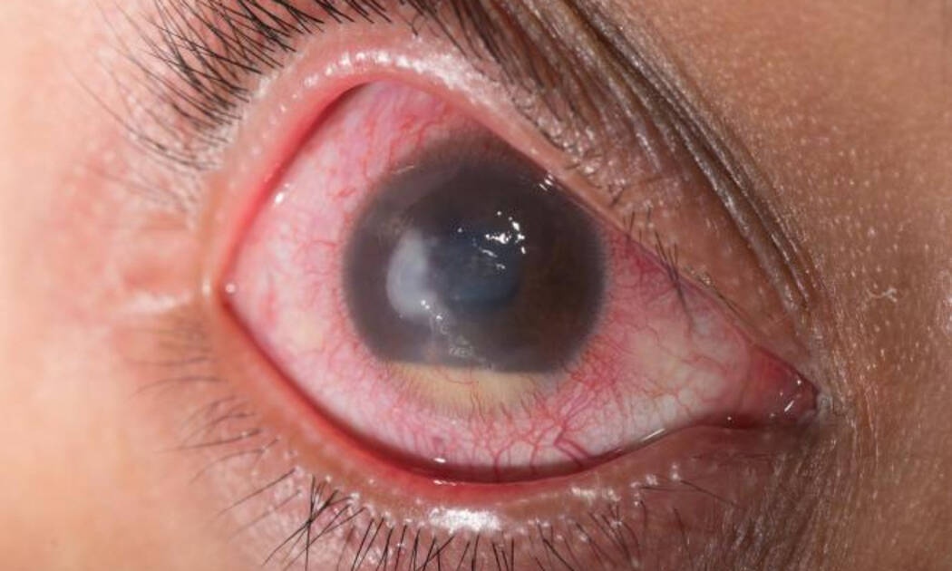 Γλαύκωμα: Τα στοιχεία που αντιμετωπίζουν τα συμπτώματα (εικόνες)