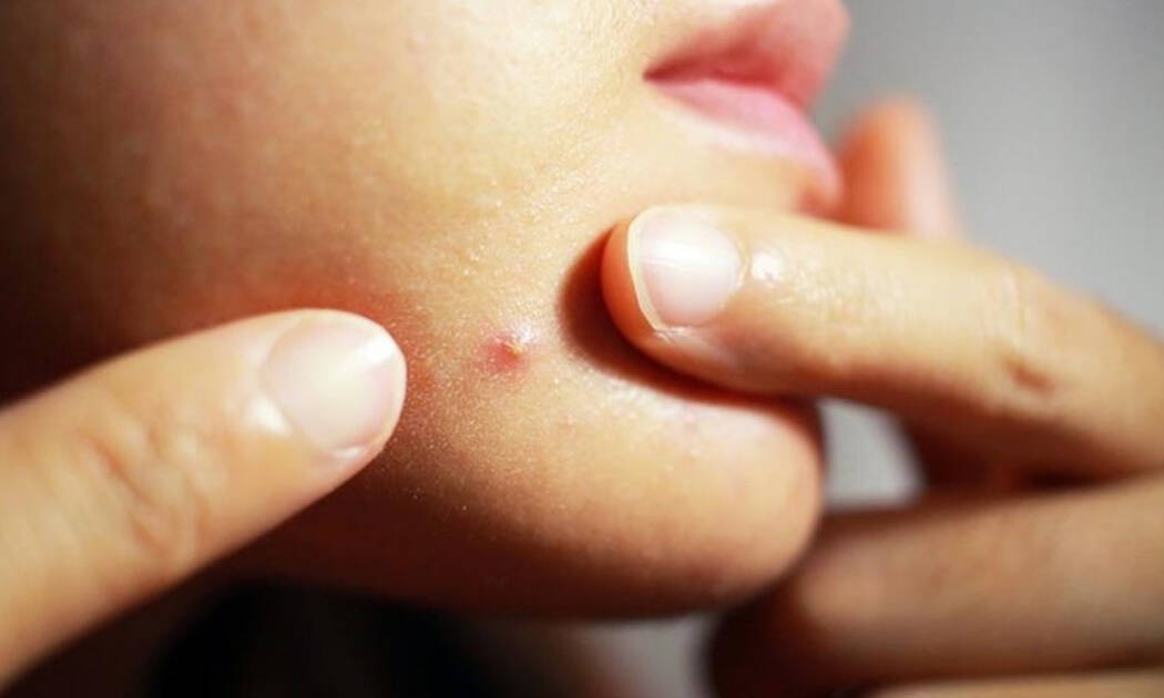 Ακμή στο πιγούνι: Αίτια και αντιμετώπιση