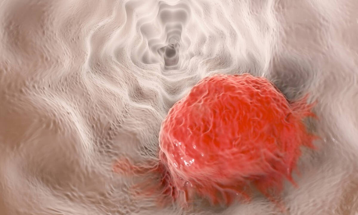 Ανθοκυανίνες: Η αντικαρκινική τους δράση και πού θα τις βρείτε