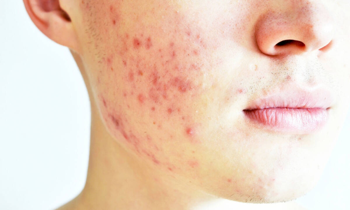 Ακμή: Το smoothie που μειώνει τις εξάρσεις