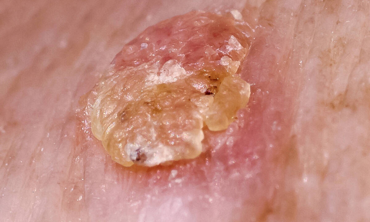 Ακτινική υπερκεράτωση: Μπορεί να εξελιχθεί σε καρκίνο;