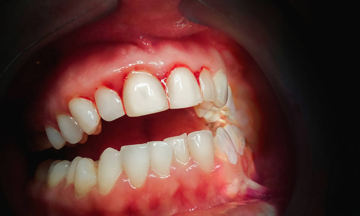 Πώς η ουλίτιδα επηρεάζει την υγεία της καρδιάς