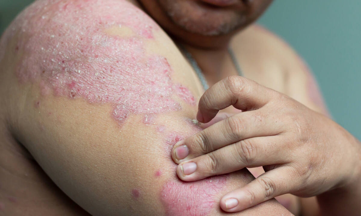 Μήπως έχετε ψωρίαση; Δείτε τα «ύποπτα» συμπτώματα σε εικόνες