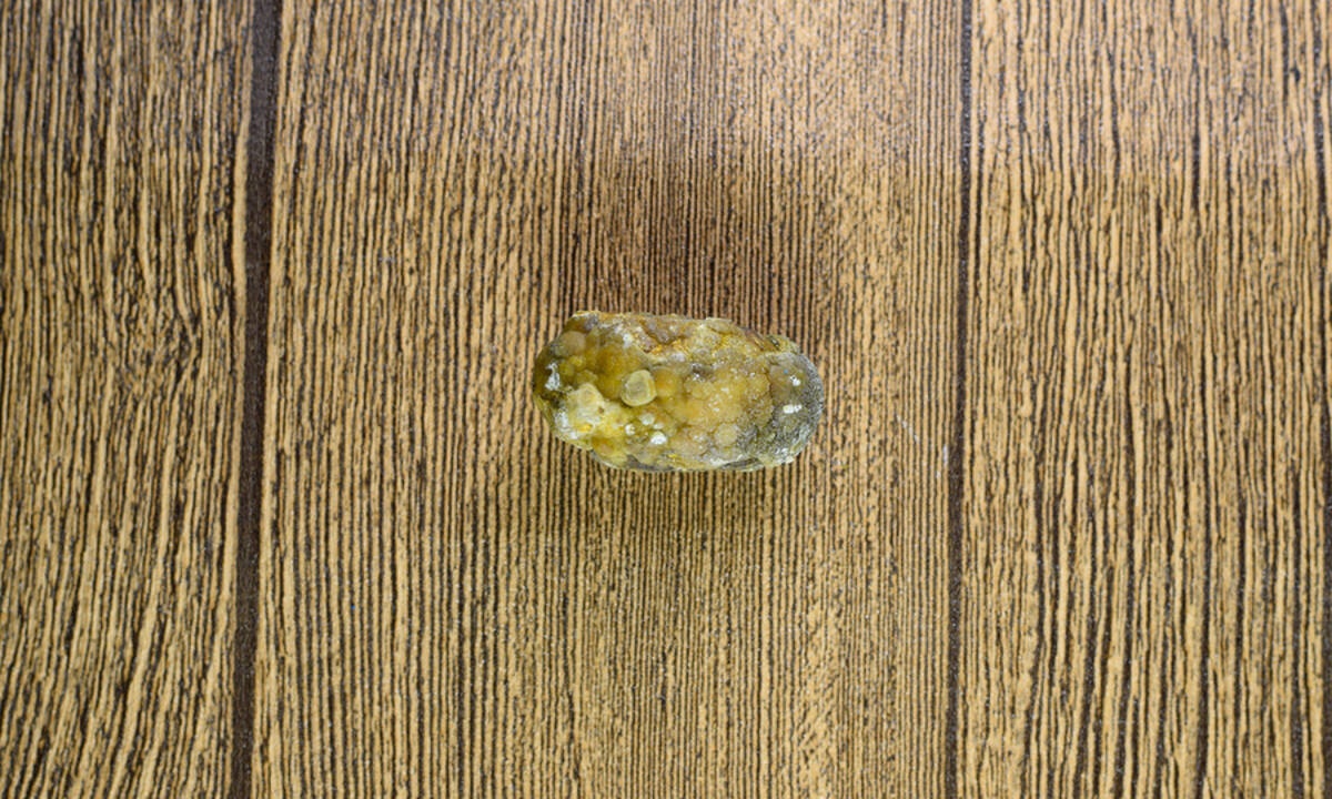 Πέτρες στη χολή: Ποιοι κινδυνεύουν περισσότερο (εικόνες)