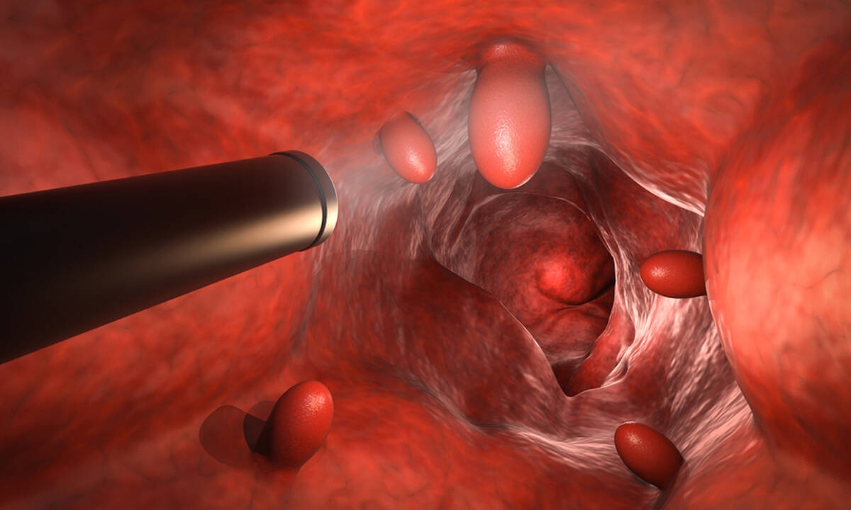 Τι συμβαίνει κατά τη διάρκεια της κολονοσκόπησης και μετά από αυτή (βίντεο)