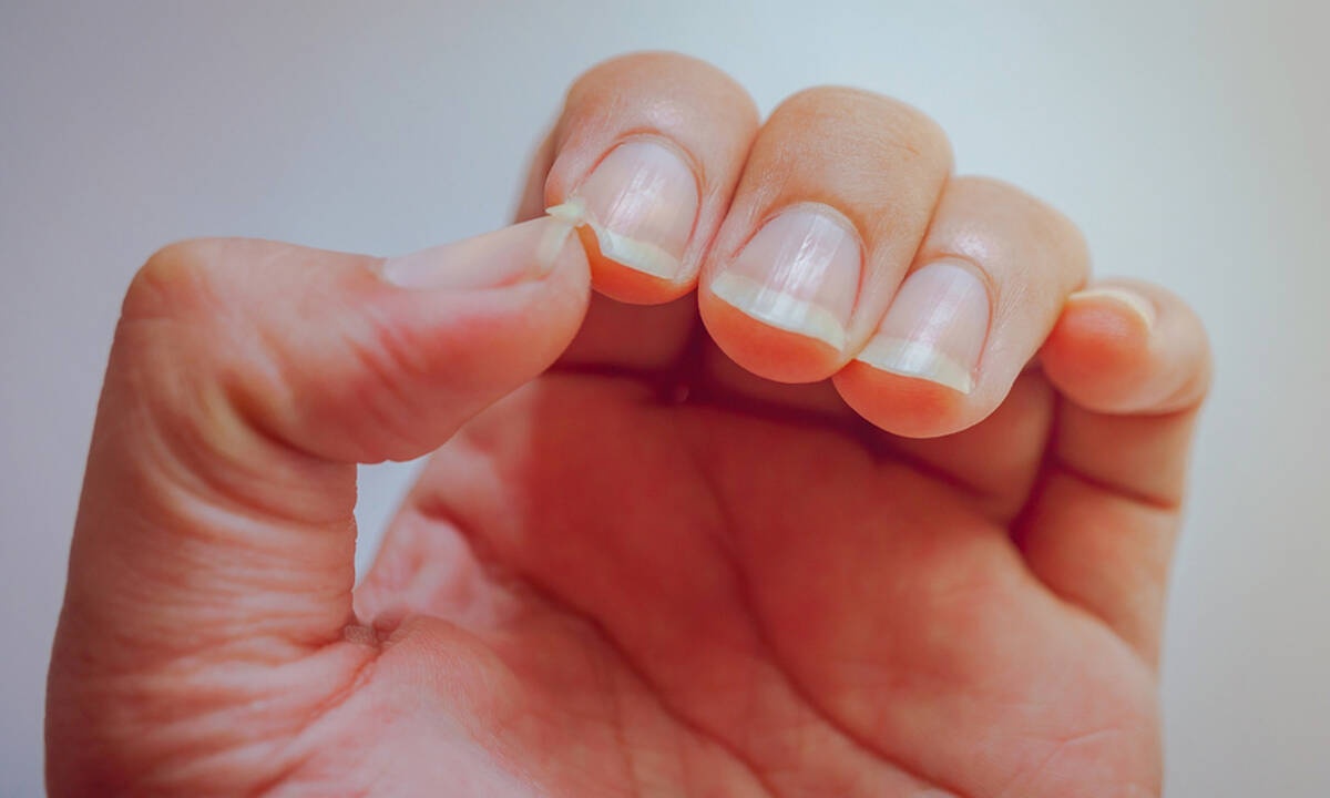 Νύχια που σπάνε: Οι 7 βασικές αιτίες σε εικόνες