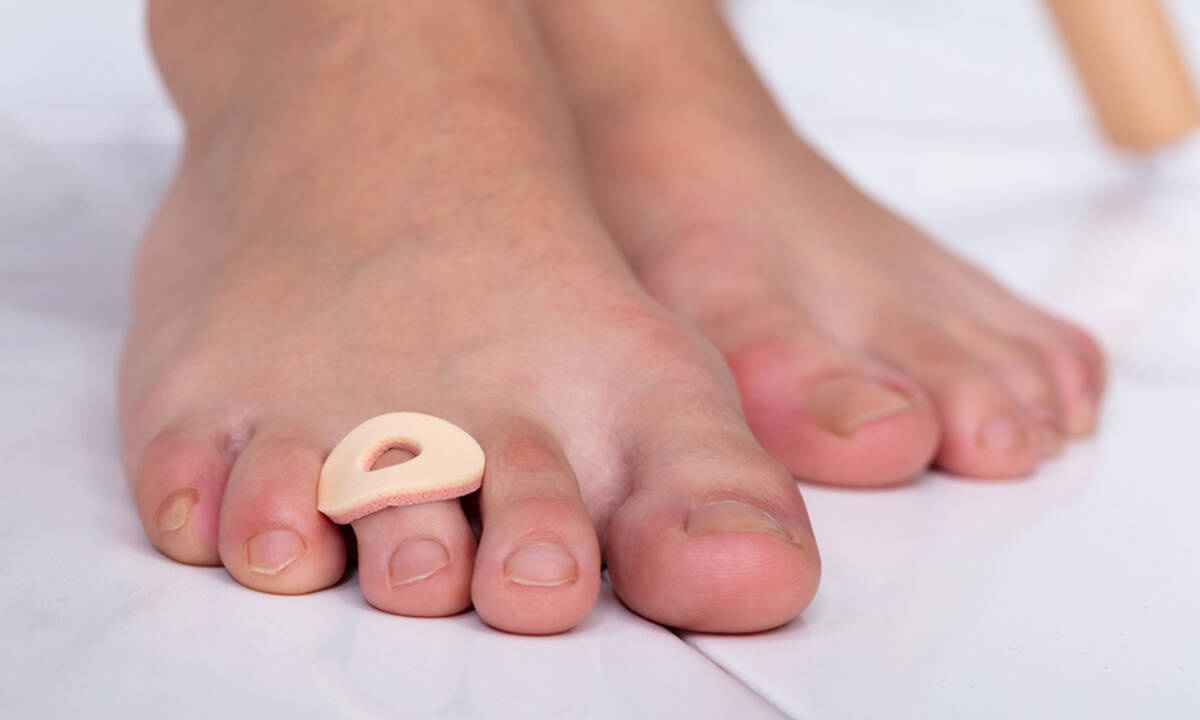 Κάλοι: Πώς δημιουργούνται και πώς θα τους αντιμετωπίσετε