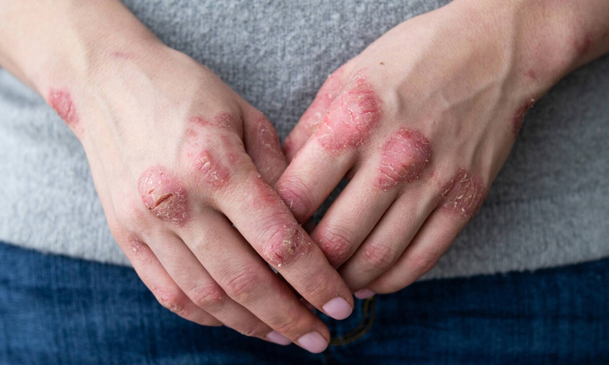 Ψωρίαση: Οι τροφές που αμβλύνουν τα συμπτώματα (εικόνες)