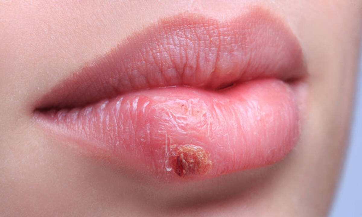 Επιχείλιος έρπης: Πώς θα τον προλάβετε (εικόνες)