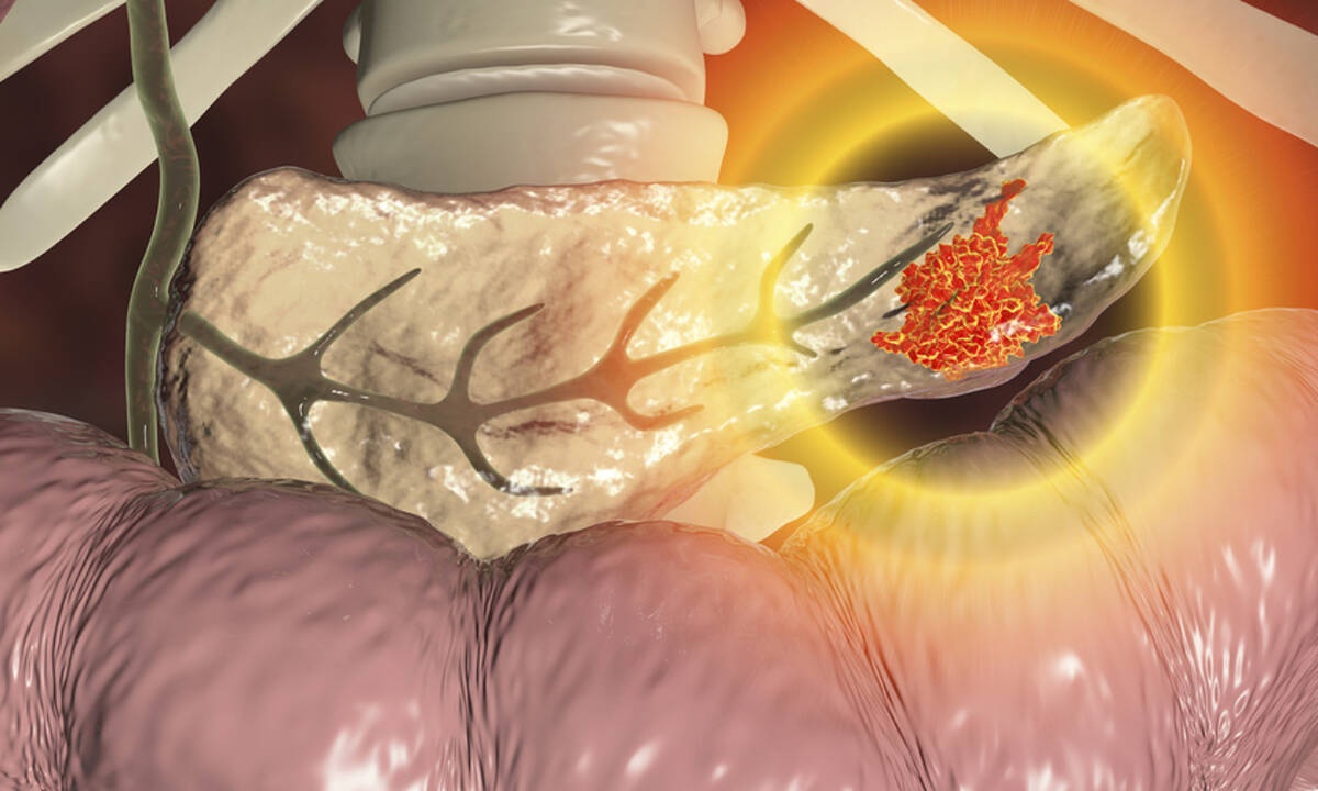 Πάγκρεας: Τα ανησυχητικά σημάδια που πρέπει να γνωρίζετε (εικόνες)