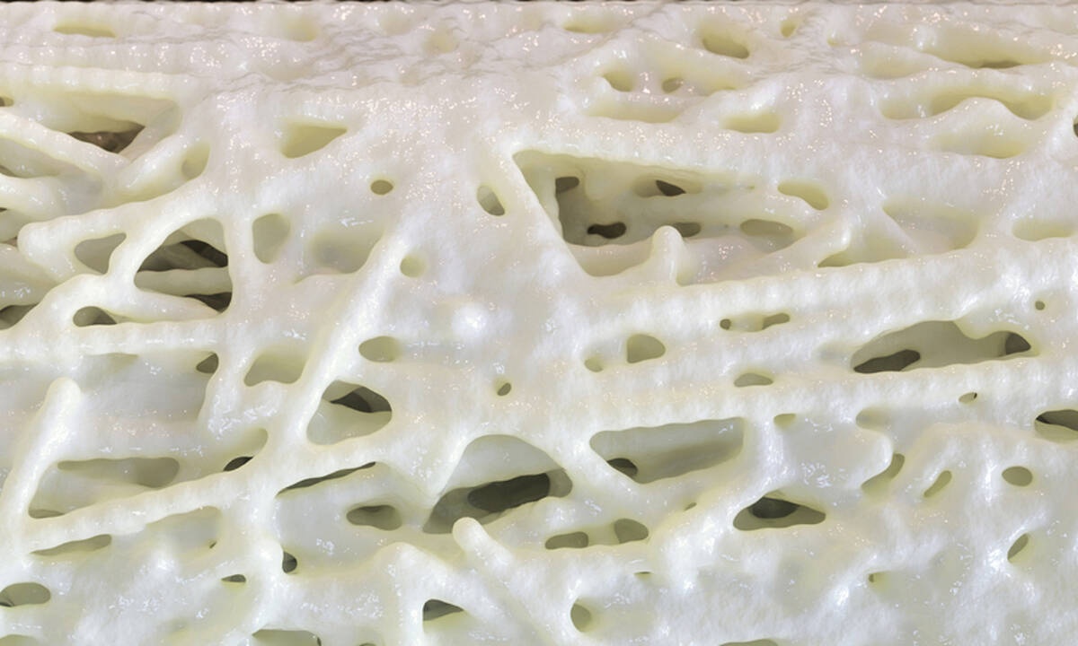 Πώς αναπτύσσεται η οστεοπόρωση (βίντεο)