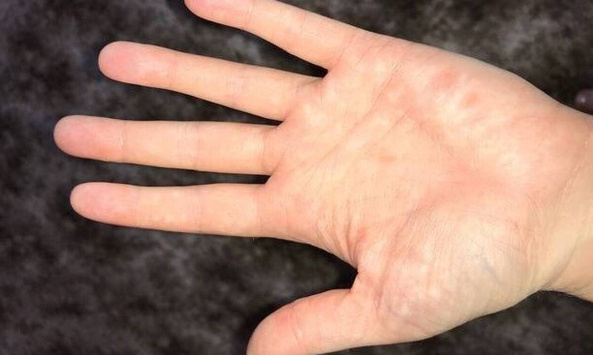 Έβγαλε αυτά τα εξανθήματα - Όταν τα είδε ο γιατρός έμαθε την φρικτή αλήθεια