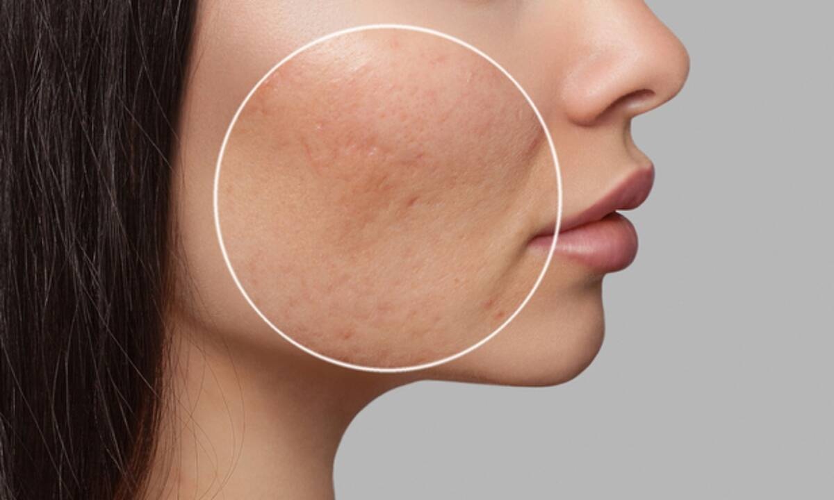 Ακμή: 15 απίθανες αιτίες σε βίντεο