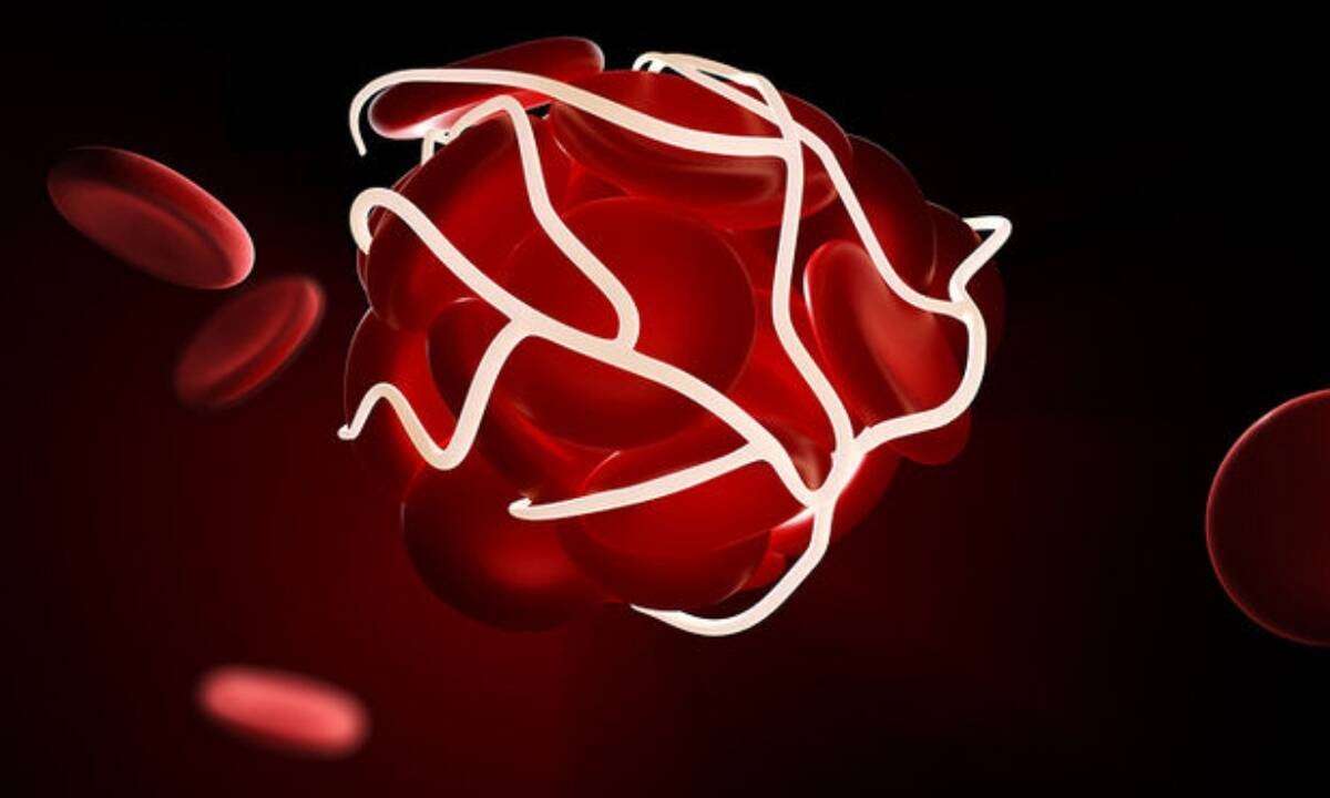 Θρόμβωση: Οι 4 βασικοί κανόνες πρόληψης (εικόνες)