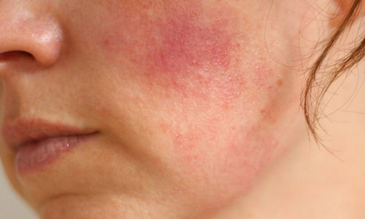 Λύκος: 5 βασικά συμπτώματα της αυτοάνοσης πάθησης (εικόνες)