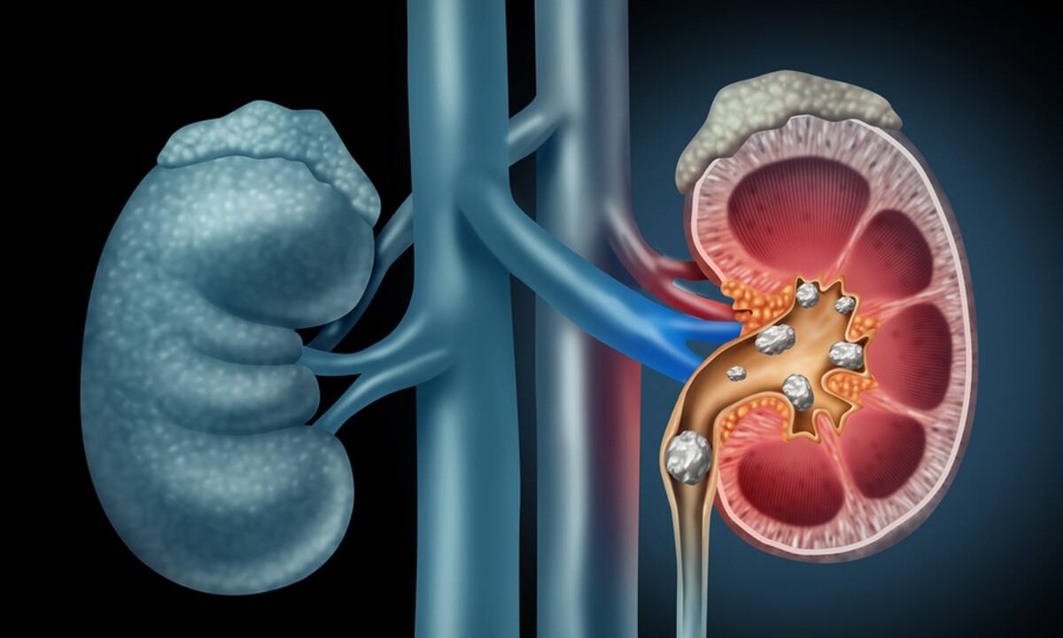 Πέτρες στα νεφρά: Τι πρέπει να προσέχετε στη διατροφή για να τις προλάβετε (εικόνες)