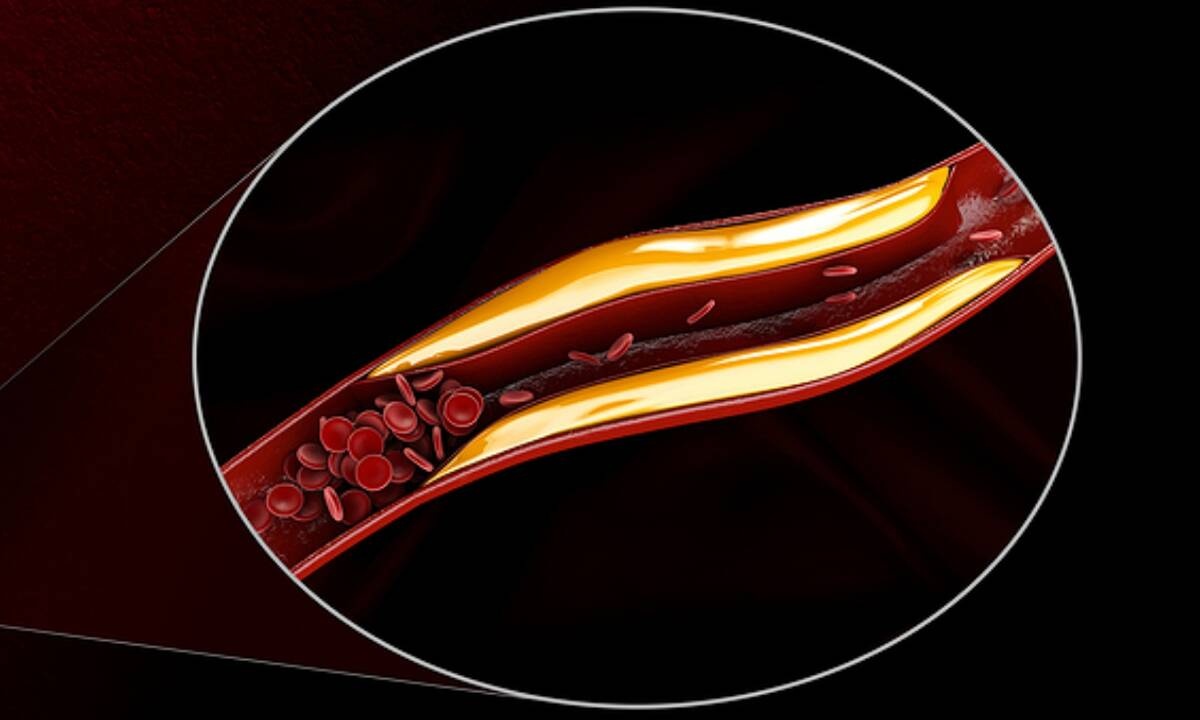 Υψηλή χοληστερόλη: Τι πρέπει να αποκλείσετε από τη διατροφή