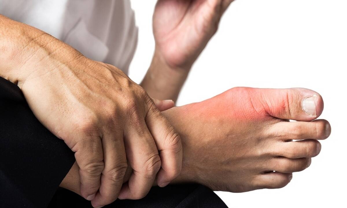 Ουρική αρθρίτιδα: Ανησυχητική αύξηση των ποσοστών - Ποιο φύλο προτιμά