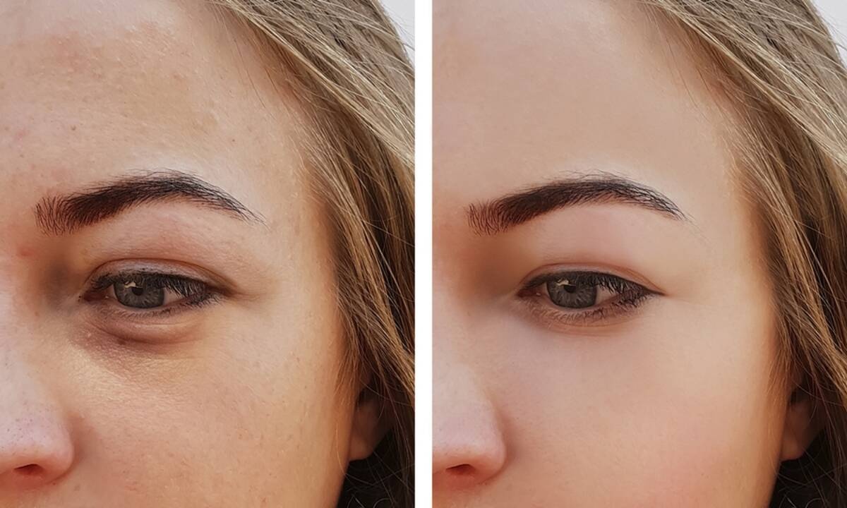 Σακούλες κάτω από τα μάτια: Πώς θα τις εξαφανίσετε (εικόνες)