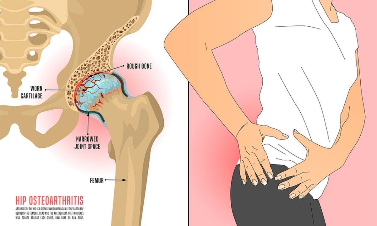 Κάταγμα ισχίου: Ποιες γυναίκες κινδυνεύουν περισσότερο