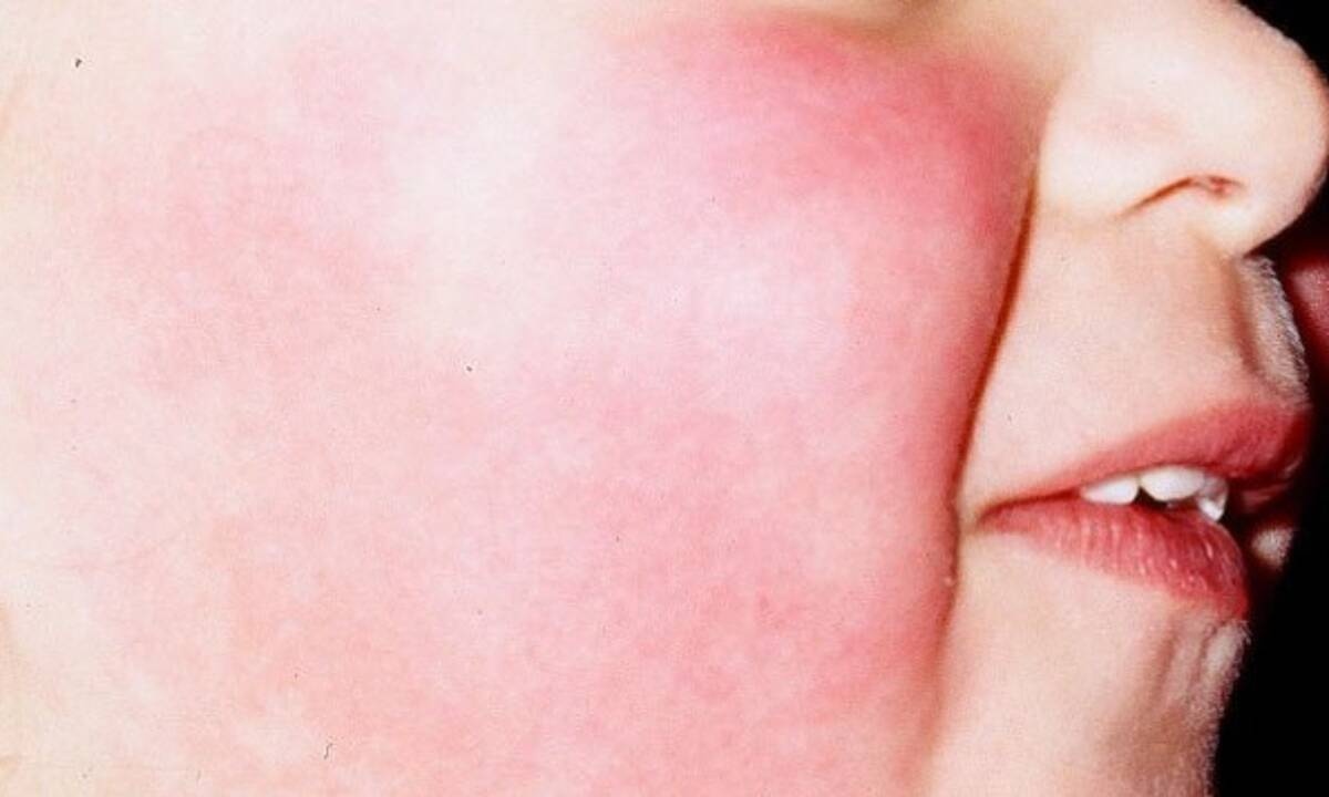 Λοιμώδες ερύθημα ή 5η νόσος: Τα συμπτώματα της παιδικής ασθένειας (εικόνες)