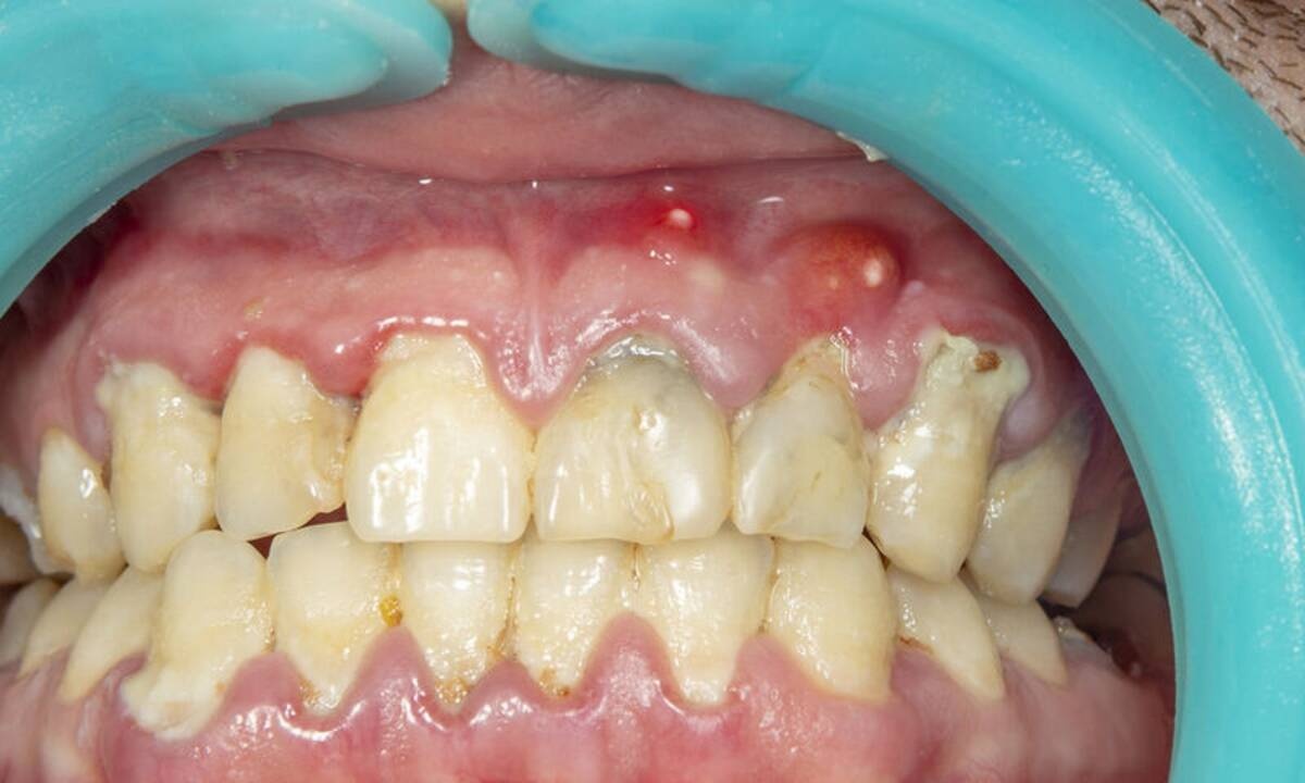 Απόστημα στο δόντι: 4 φυσικοί τρόποι αντιμετώπισης (εικόνες)