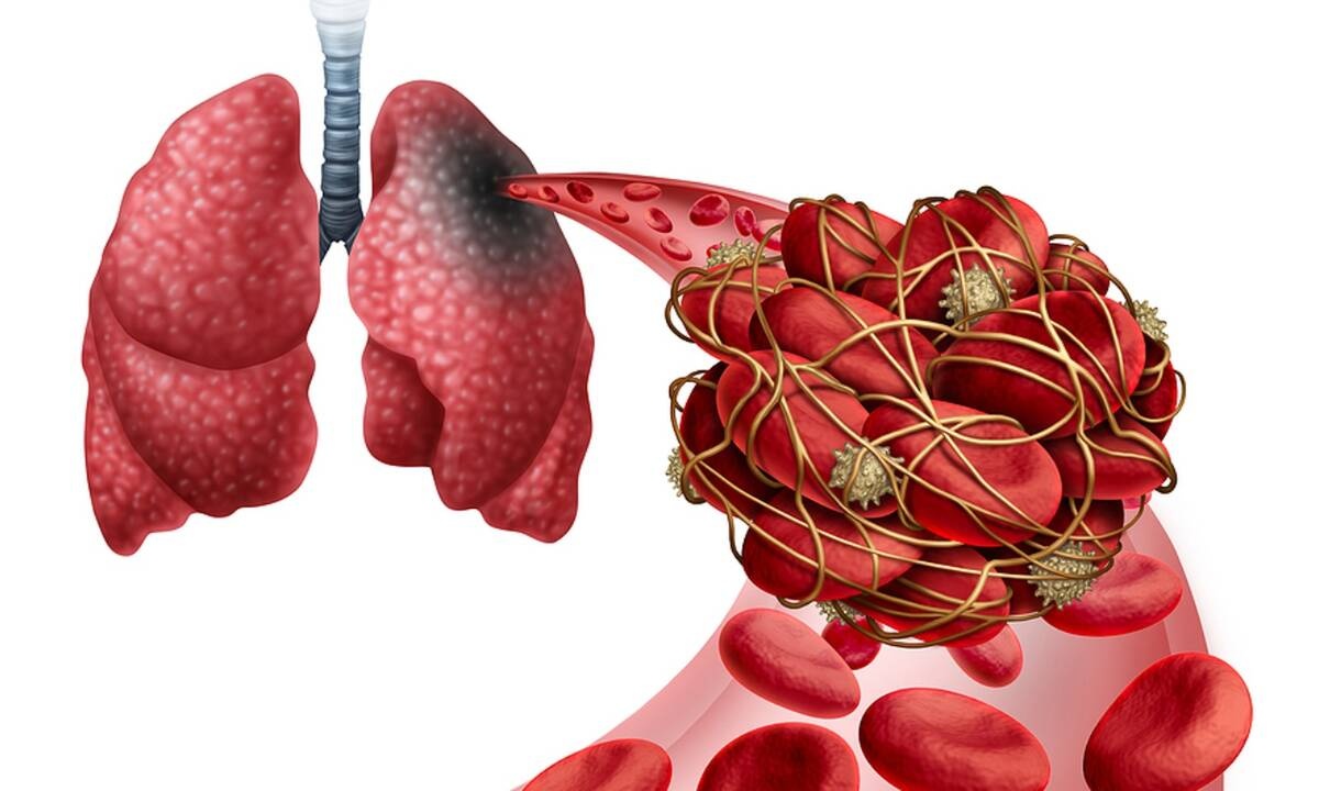 Πνευμονική εμβολή: Πότε πρέπει να αναζητήσετε επειγόντως ιατρική βοήθεια (εικόνες)