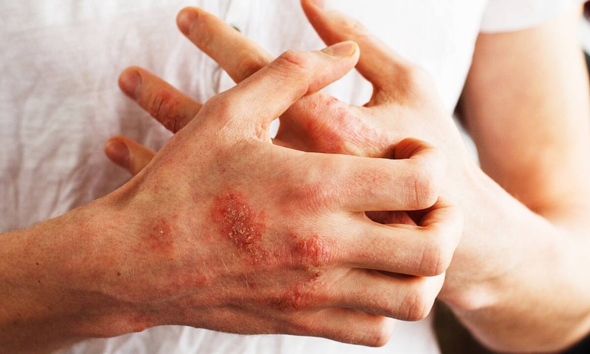 Αυτοάνοσα: Οι βασικές ενδείξεις που πρέπει να γνωρίζετε (εικόνες)