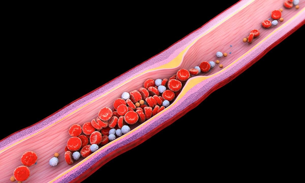 Υψηλή χοληστερίνη: Οι άγνωστες επιπτώσεις πλην του εμφράγματος και του εγκεφαλικού (εικόνες)