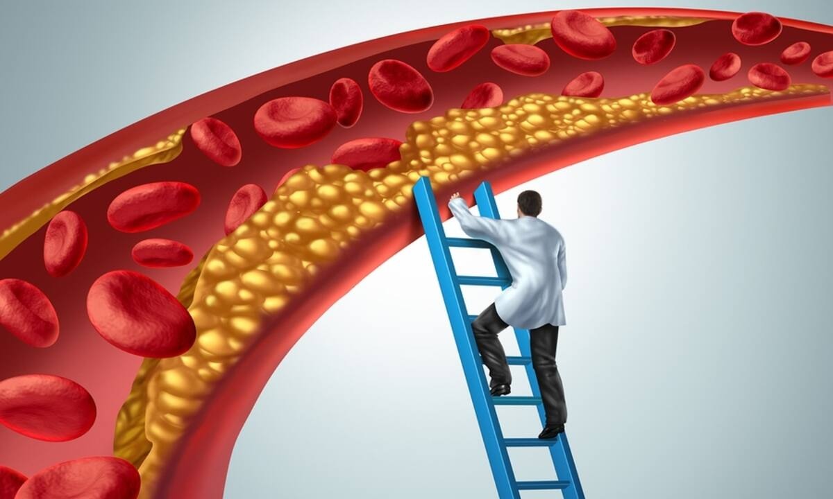 Στένωση αρτηριών: Τι να τρώτε και τι να αποφεύγετε (εικόνες)