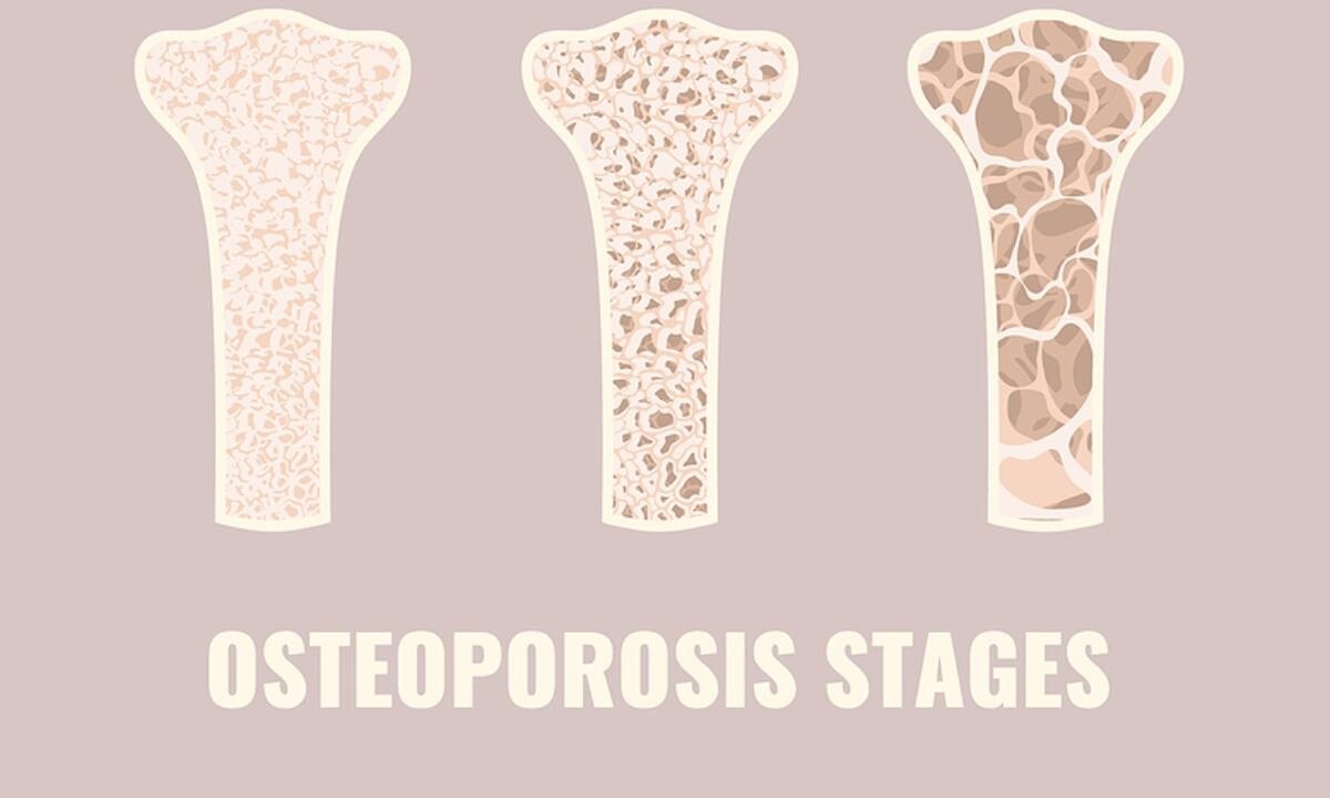 Μέτρηση οστικής πυκνότητας: Ποιοι και πότε πρέπει να κάνουν την εξέταση (εικόνες)