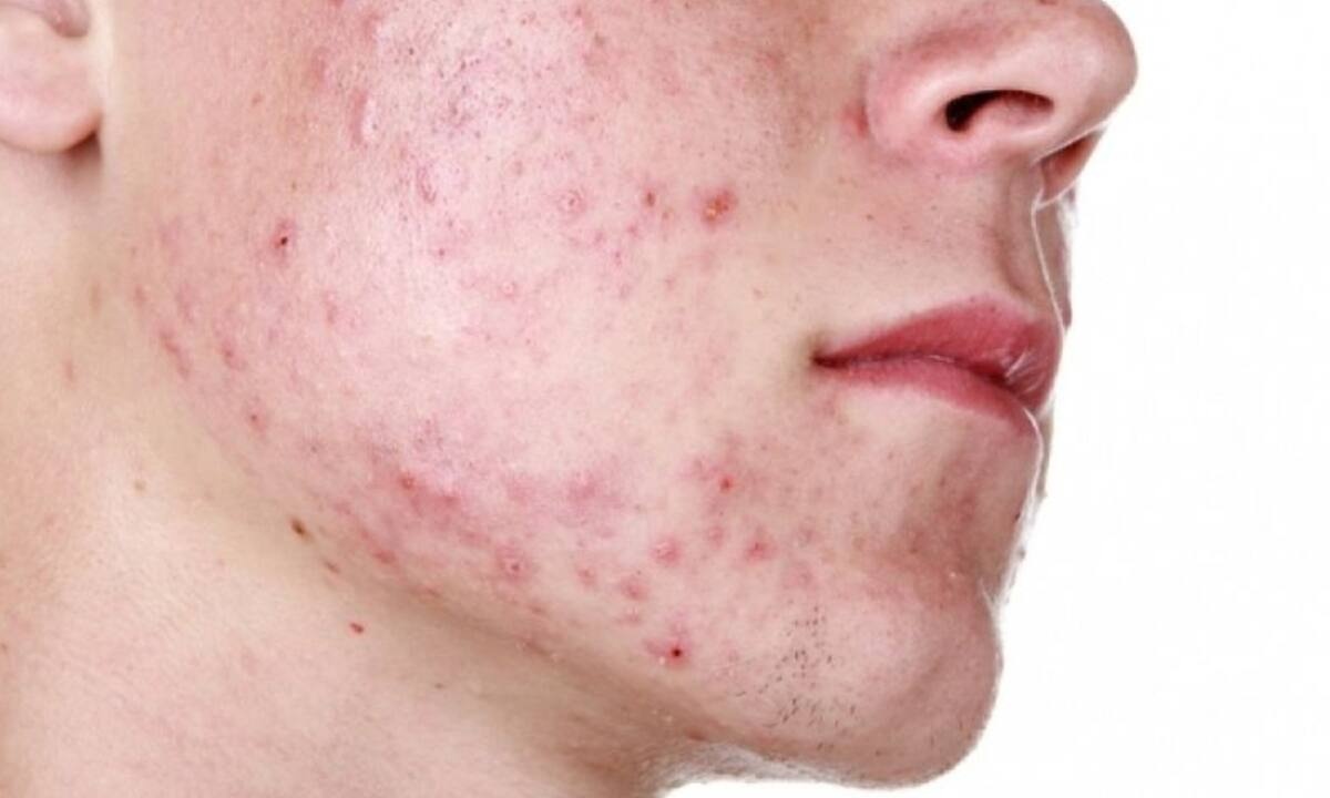 Κυστική ακμή: 4 τρόποι αντιμετώπισης με σπιτικά υλικά (video)