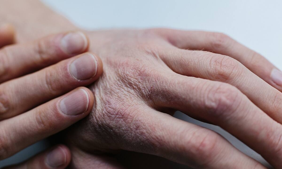 Παθήσεις δέρματος: Ποιες επιδεινώνονται με το κρύο (εικόνες)