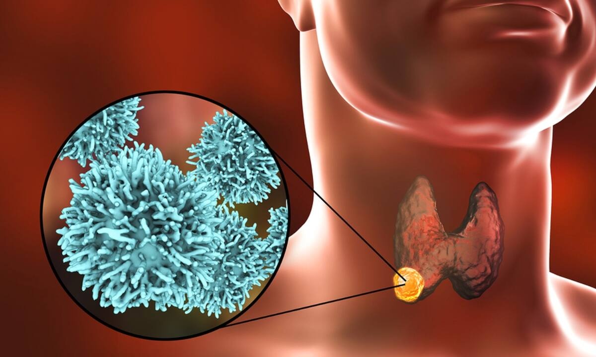 Καρκίνος θυρεοειδούς: Τα βασικά συμπτώματα σε εικόνες