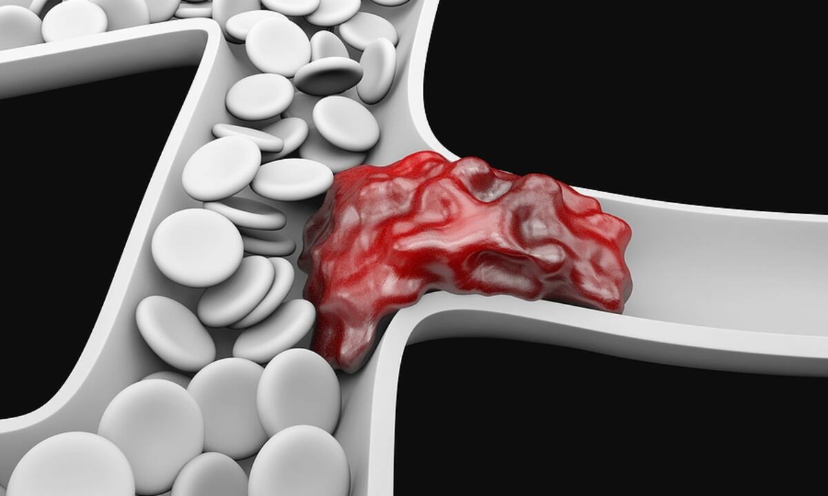 Θρόμβωση: Οι σημαντικοί παράγοντες κινδύνου (εικόνες)