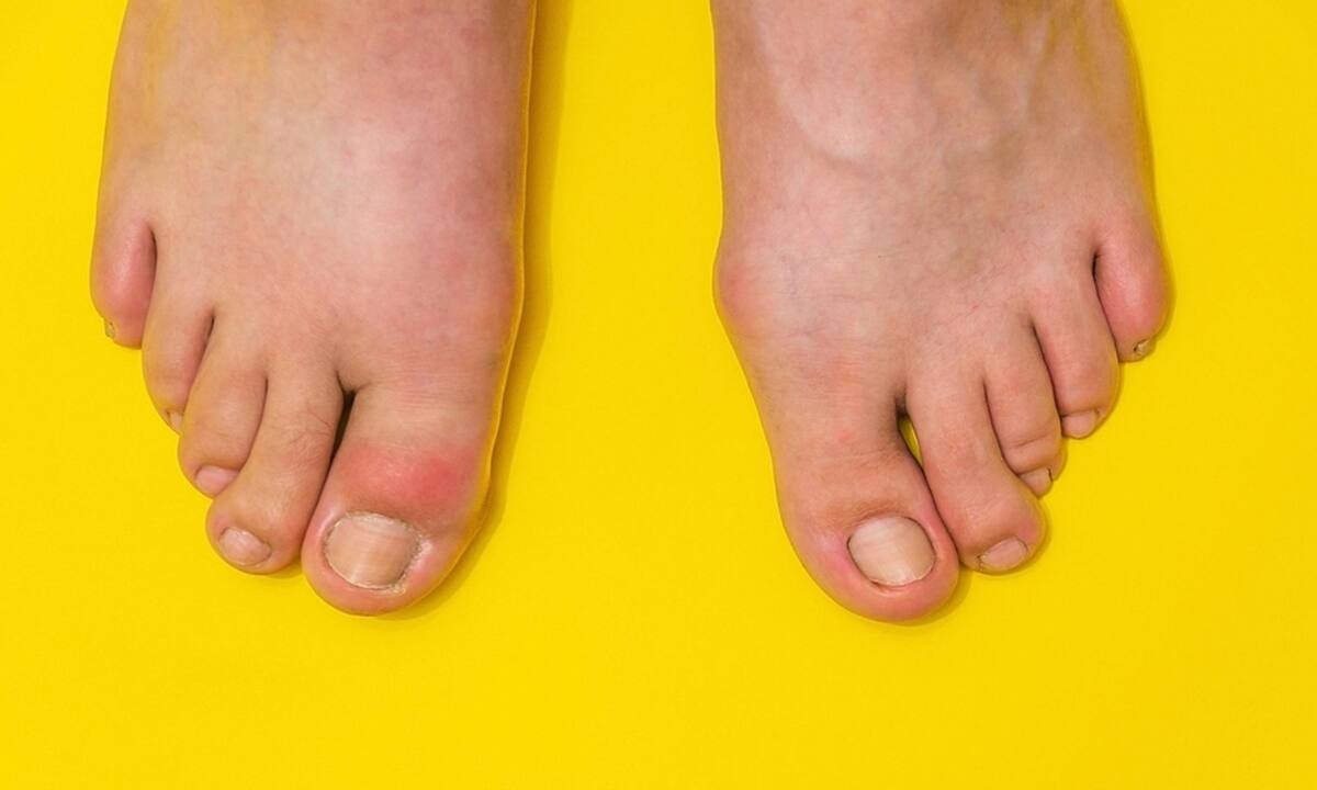 Οι 20 τροφές που μειώνουν τα επίπεδα ουρικού οξέος (βίντεο)