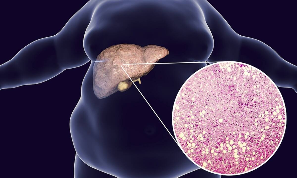 Οι επιπτώσεις της παχυσαρκίας στο πεπτικό (εικόνες)