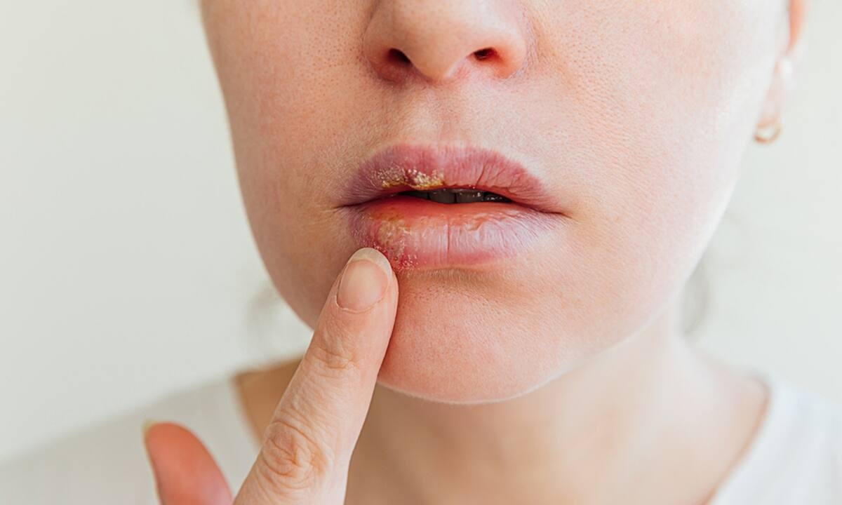 Επιχείλιος έρπης: Φυσικοί τρόποι αντιμετώπισης (εικόνες)