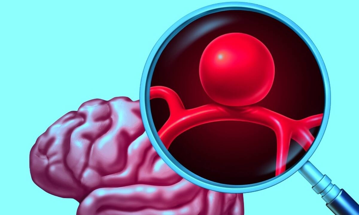 Ανεύρυσμα: Οι κύριες αιτίες ρήξης (εικόνες)